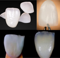 Veneers, Dental Veneers and laminates, porcelain veneers lab